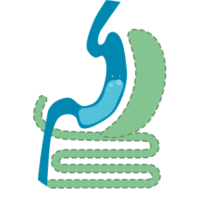 duodenal switch graphic