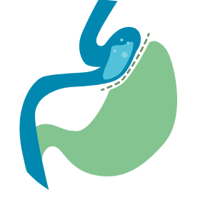 gastric bypass graphic icon
