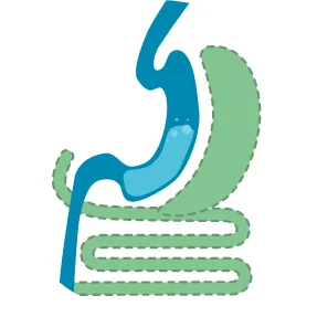 graphic icon of duodenal switch procedure