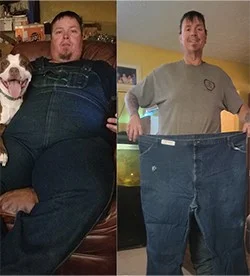 After Weight Loss Surgery in Jacksonville, FL